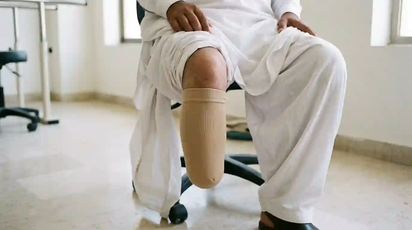 A shrinker sock on a healed below knee stump